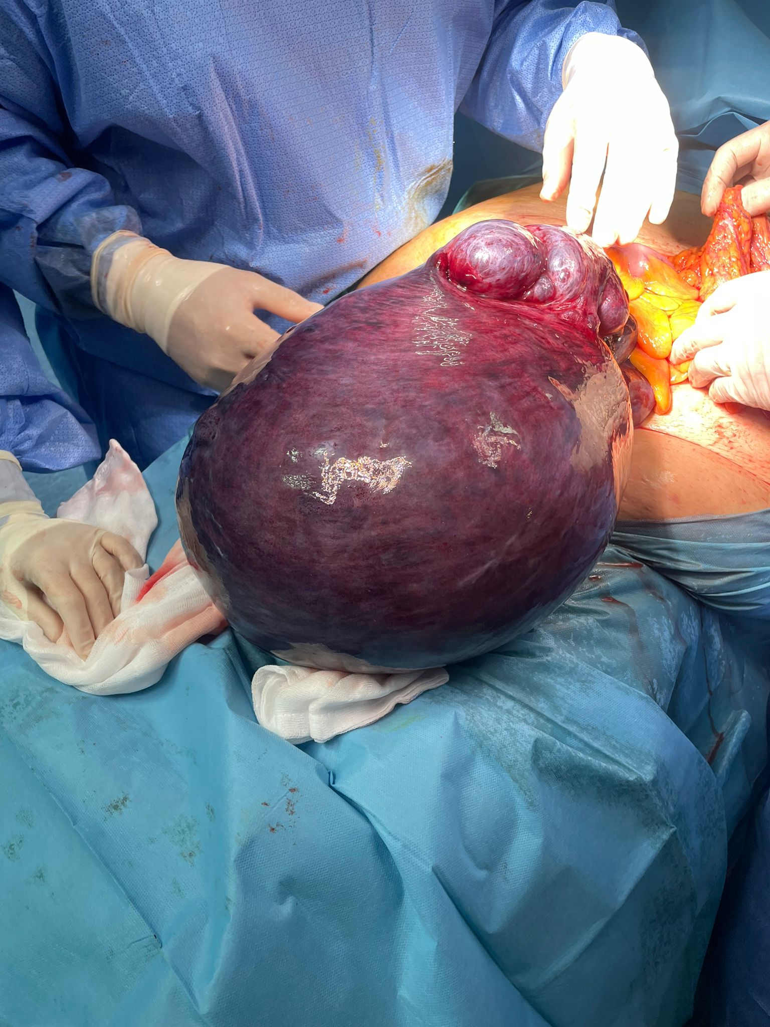 Ginecologia: asportato fibroma dell’utero di 16 kg all’ospedale di Marsala